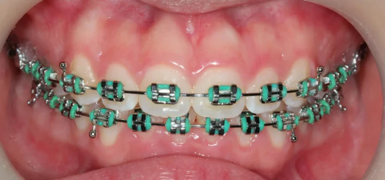 Ortodontik Tedavide En Sık Yapılan Hatalar ve Çözümleri